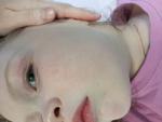 Вены на теле и лице у ребёнка 5 лет фото 3