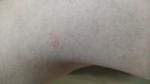 Розовая сыпь на теле, не вызывающая беспокойства фото 2