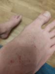 Сыпь на ноге в виде коричневых точек фото 2