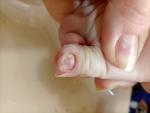 Видоизменение ногтевой пластины у ребенка фото 1