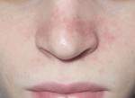 Покраснение на носу раньше шелушение было фото 1