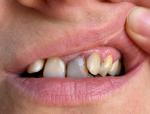Нарост на десне после повреждения зубной нитью фото 1