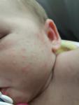 Аллергия у новорожденного фото 2