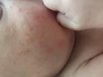 Аллергия у новорожденного фото 1