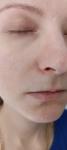 Сыпь возле носа, аллергия фото 3