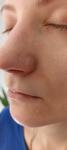 Сыпь возле носа, аллергия фото 2
