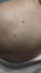 Беспигментная меланома на плече или рубец? фото 2