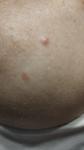 Беспигментная меланома на плече или рубец? фото 1