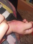 У малыша 1,8 высыпания на коже фото 1