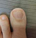 Полоса на ногте большого пальца ноги фото 1
