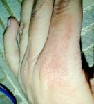 Пятна на коже пальцев рук фото 2