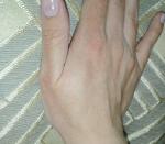 Пятна на коже пальцев рук фото 3