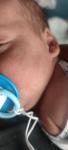 Аллергия или акне новорождённых фото 2