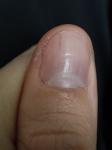 Трещина под ногтем большого пальца руки фото 3