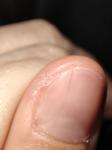 Трещина под ногтем большого пальца руки фото 1
