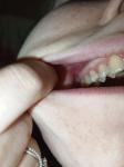 Воспаление десны, зуб мудрости фото 1