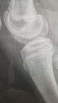Перелом бугристости большеберцовой кости со смещением фото 2