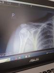 Рентген плеча, есть ли перелом либо вывих фото 1