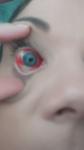 Красный глаз и гематома фото 4