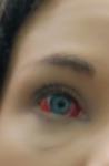 Красный глаз и гематома фото 1
