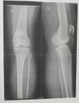 Рентген колена (боль с внутренней стороны) фото 1