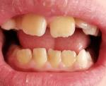 Рушатся постоянные зубы у ребенка 9 лет фото 2