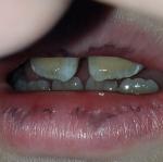 Рушатся постоянные зубы у ребенка 9 лет фото 1