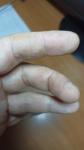 Утольщение на коже пальцев фото 1