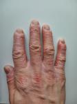 Сухость кожи пальцев рук с растрескиванием фото 2
