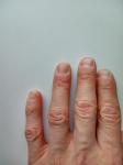 Сухость кожи пальцев рук с растрескиванием фото 3