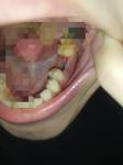 Состояние лунки после удаления 36 зуба фото 1