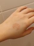 Непонятное пятно на руке с маленькими пупырками без жидкости фото 1