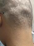 Кольцеобразное поражение волосистой части головы фото 4