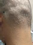 Кольцеобразное поражение волосистой части головы фото 3