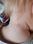 Шершавое покрасневшее пятно на шее у ребёнка 1 год фото 1