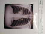 Правосторонняя пневмония, лечение после повторного рентгена фото 1