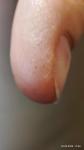 Аллергия, пузырьки на пальцах фото 4
