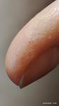 Аллергия, пузырьки на пальцах фото 2