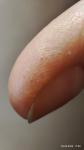 Аллергия, пузырьки на пальцах фото 1