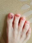 Гематома на ногте большого пальца ноги фото 1
