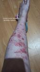 Красные раны и пятна на ноге фото 4