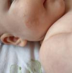 Красные пятна на щеках у 4 месячного ребенка фото 2