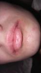 Шелушения в зоне губ и подбородка фото 1