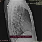 Остеохондроз боли в спине отдающие в грудной отдел фото 2