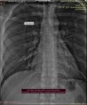 Остеохондроз боли в спине отдающие в грудной отдел фото 1