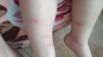 Что за пятна у ребёнка на ножках, укусы или аллергия? фото 1