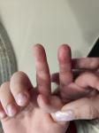 Опухла подушечка пальца у ребенка фото 3