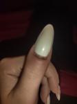Опух палец из-за прокола ногтевой пластины что делать? фото 1