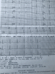 На кардиограмме замедление внутрипредсердной проводимости фото 1