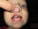 Гнилые зубы у малыша фото 1